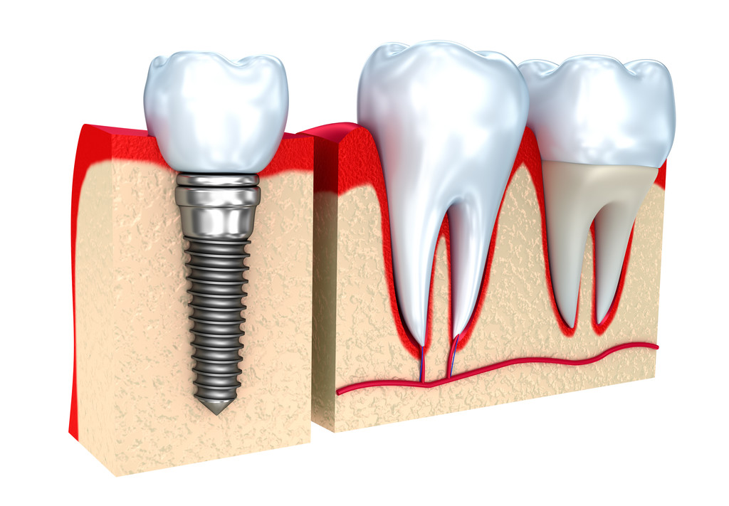 Single implant Ellenbrook