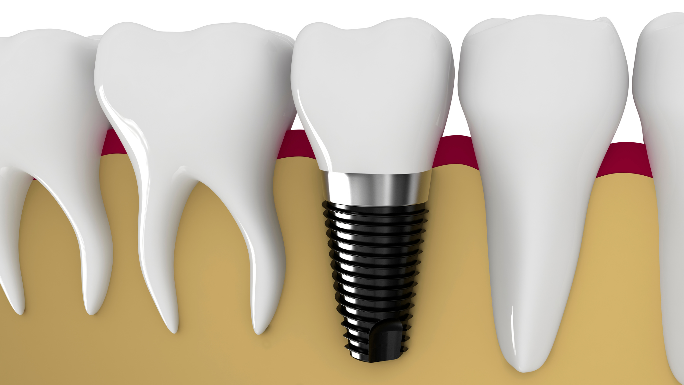 dental implant lifespan