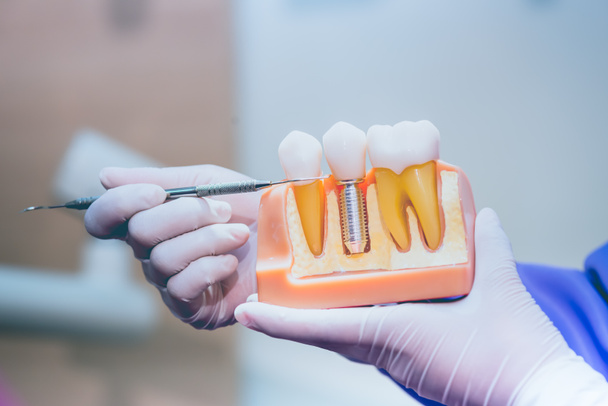 dentist tooth implant false teeth dentistry healthcare concept dental clinic