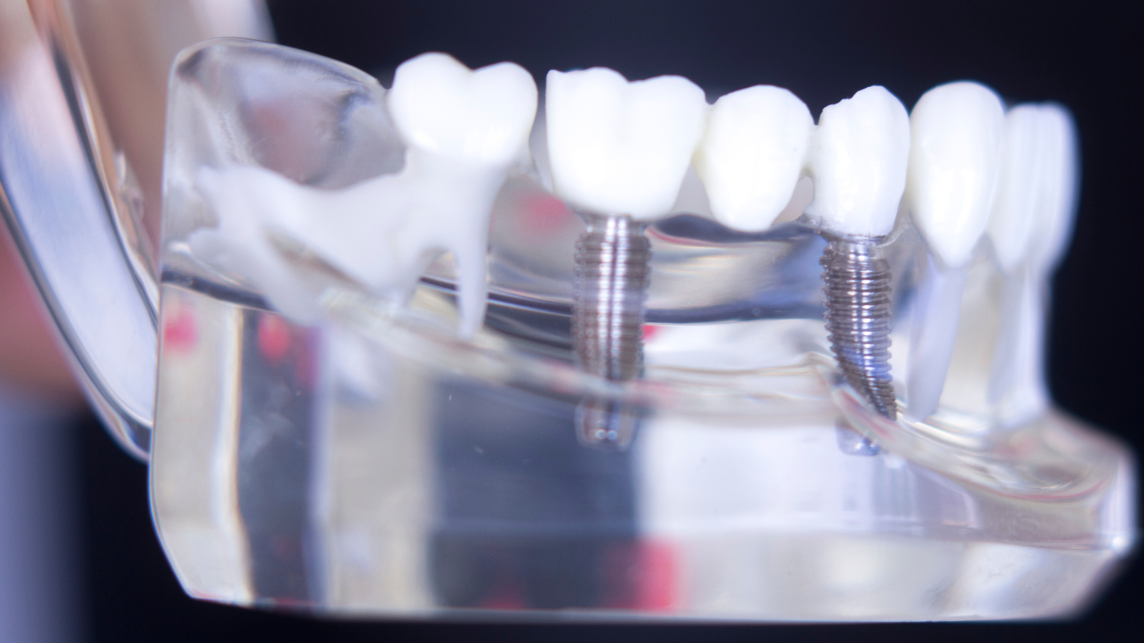 all on 4 dental implant